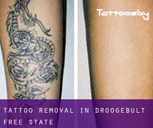 Tattoo Removal in Droogebult (Free State)