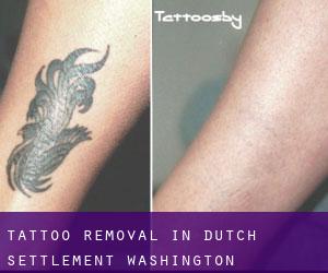 Tattoo Removal in Dutch Settlement (Washington)