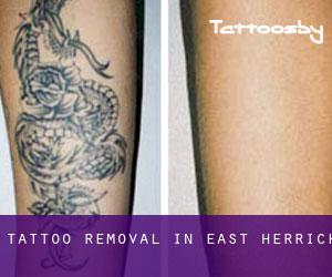 Tattoo Removal in East Herrick