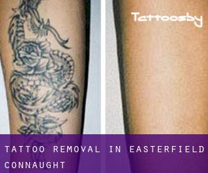 Tattoo Removal in Easterfield (Connaught)