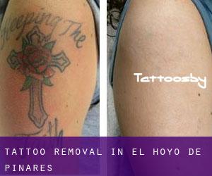 Tattoo Removal in El Hoyo de Pinares