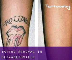 Tattoo Removal in Elizabethville