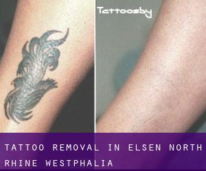 Tattoo Removal in Elsen (North Rhine-Westphalia)