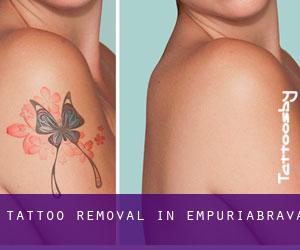 Tattoo Removal in Empuriabrava