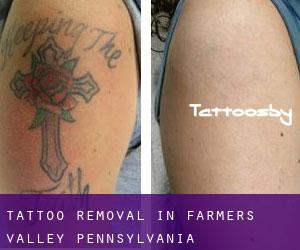 Tattoo Removal in Farmers Valley (Pennsylvania)