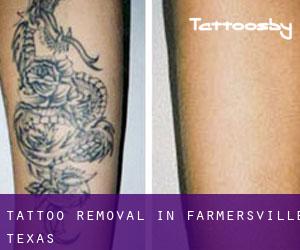 Tattoo Removal in Farmersville (Texas)