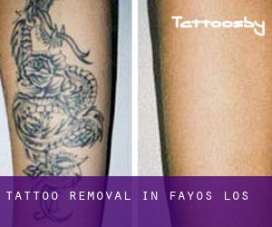 Tattoo Removal in Fayos (Los)