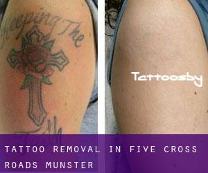 Tattoo Removal in Five Cross Roads (Munster)