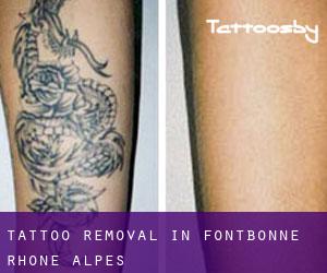 Tattoo Removal in Fontbonne (Rhône-Alpes)