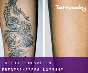 Tattoo Removal in Frederiksberg Kommune