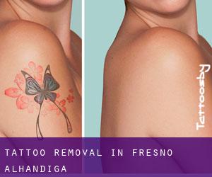 Tattoo Removal in Fresno Alhándiga