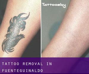 Tattoo Removal in Fuenteguinaldo