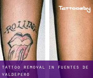 Tattoo Removal in Fuentes de Valdepero