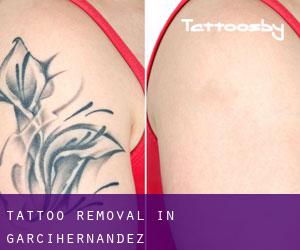 Tattoo Removal in Garcihernández