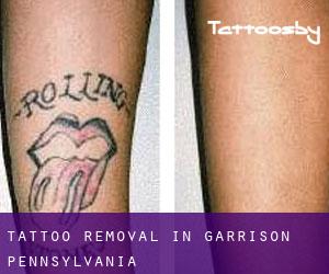 Tattoo Removal in Garrison (Pennsylvania)