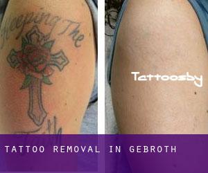 Tattoo Removal in Gebroth