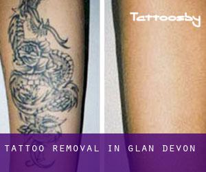 Tattoo Removal in Glan Devon