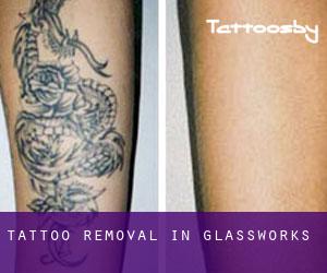 Tattoo Removal in Glassworks