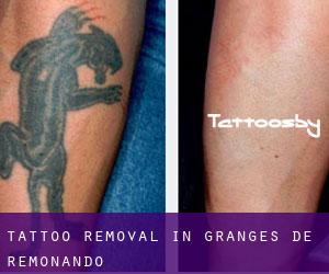 Tattoo Removal in Granges de Remonando