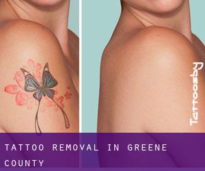 Tattoo Removal in Greene County