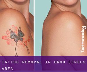 Tattoo Removal in Grou (census area)