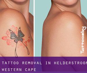 Tattoo Removal in Helderstroom (Western Cape)