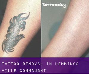 Tattoo Removal in Hemming's Ville (Connaught)