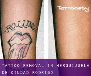 Tattoo Removal in Herguijuela de Ciudad Rodrigo