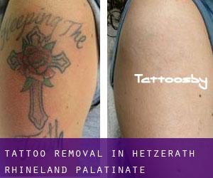 Tattoo Removal in Hetzerath (Rhineland-Palatinate)