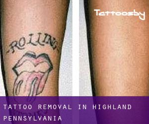 Tattoo Removal in Highland (Pennsylvania)