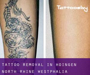 Tattoo Removal in Höingen (North Rhine-Westphalia)