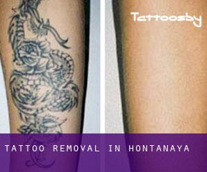 Tattoo Removal in Hontanaya