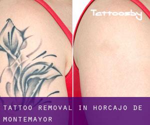 Tattoo Removal in Horcajo de Montemayor