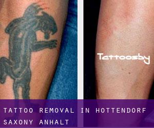 Tattoo Removal in Hottendorf (Saxony-Anhalt)