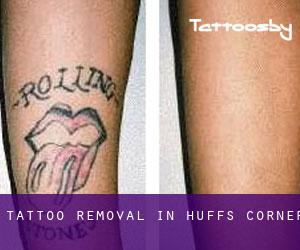 Tattoo Removal in Huffs Corner