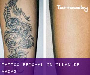 Tattoo Removal in Illán de Vacas