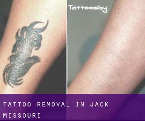 Tattoo Removal in Jack (Missouri)