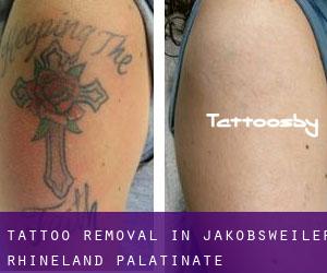 Tattoo Removal in Jakobsweiler (Rhineland-Palatinate)