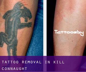 Tattoo Removal in Kill (Connaught)