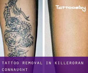 Tattoo Removal in Killeroran (Connaught)