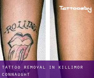 Tattoo Removal in Killimor (Connaught)