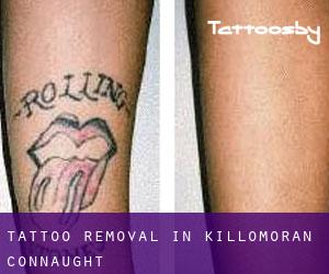 Tattoo Removal in Killomoran (Connaught)