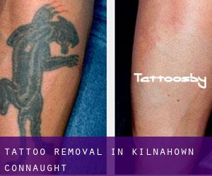 Tattoo Removal in Kilnahown (Connaught)