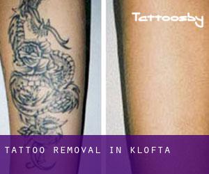 Tattoo Removal in Kløfta