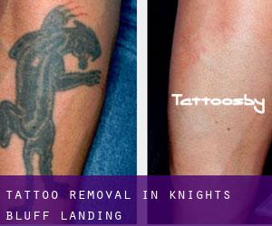 Tattoo Removal in Knights Bluff Landing