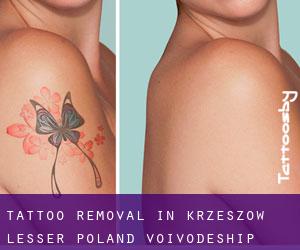 Tattoo Removal in Krzeszów (Lesser Poland Voivodeship)