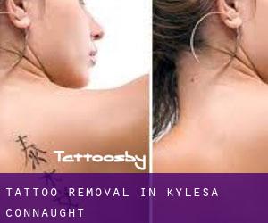 Tattoo Removal in Kylesa (Connaught)