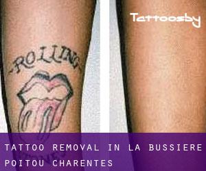 Tattoo Removal in La Bussière (Poitou-Charentes)