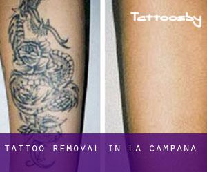 Tattoo Removal in La Campana