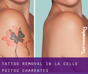 Tattoo Removal in La Celle (Poitou-Charentes)